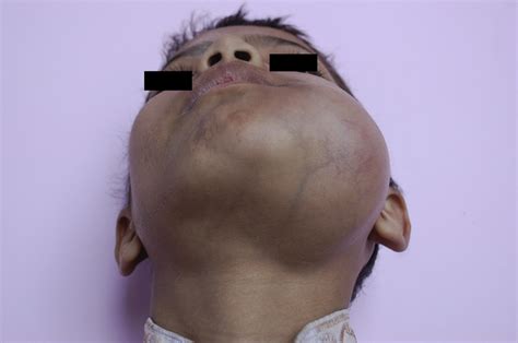 Young Male With Rapidly Swelling Jaw Annals Of Emergency Medicine