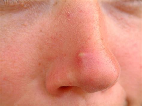 Acne Cyst On Nose
