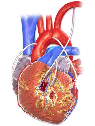 Coronary Artery Bypass Graft Surgery Cabg Condition Room