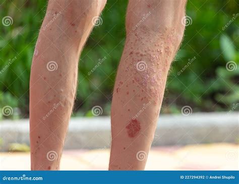 Fungus On The Skin Of The Leg Stock Photo Image Of Medical