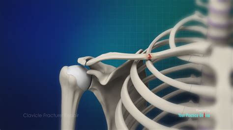 Clavicle Fracture Video Medical Video Library
