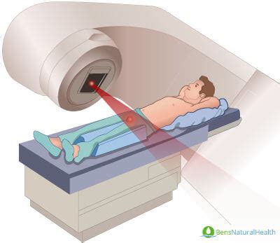 External Beam Radiation Therapy Ebrt For Prostate Cancer The Best Picture Of Beam