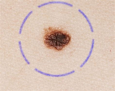 People With More Than 11 Moles On One Arm Have An Increased Risk Of