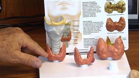 Graves Disease Or Diffuse Thyrotoxic Goiter Hyperthyroidism