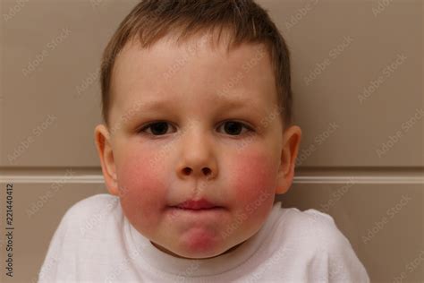 Foto Stock The Boy Has Red Cheeks A Rash On His Cheeks In The Child A