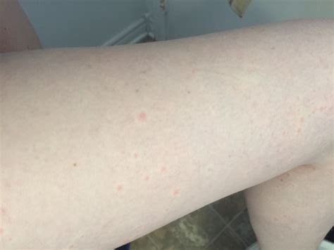 Red Itchy Bumps On Forearm