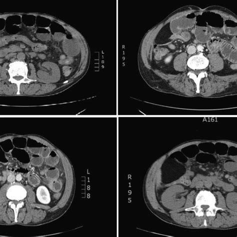 Contrast Enhanced Ct Abdominal Scan Showed A Dilated Intestine With
