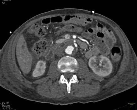 Aortic Dissection In Abdominal Aorta Following Repair Of Thoracic Aorta