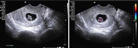 Early Twin Pregnancy Ultrasound