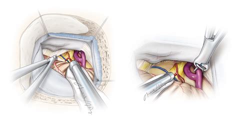Infratentorial Dural Arteriovenous Fistulas The Neurosurgical Atlas