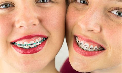 Coloured Braces Greater Vancouver Bc