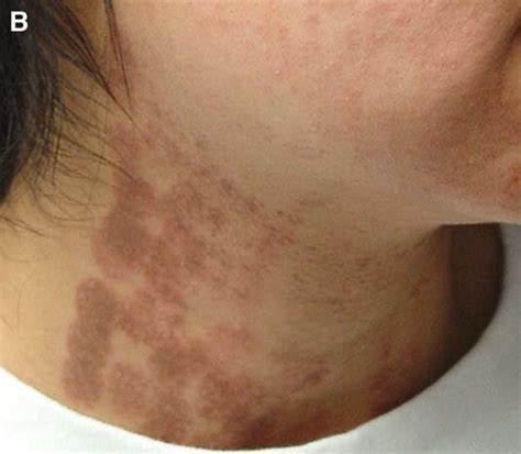 A Follicular And Slightly Generalized Urticaria After Laser Hair