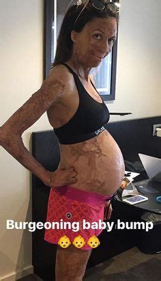 Inspirational Turia Pitt Shows Off Her Miraculous Baby Bump Dresses To Wear To A Wedding Baby