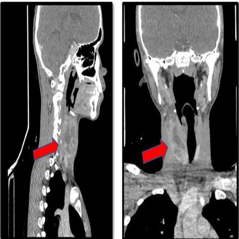 Right Sided Neck Swelling With Left Sided Tracheal Deviation