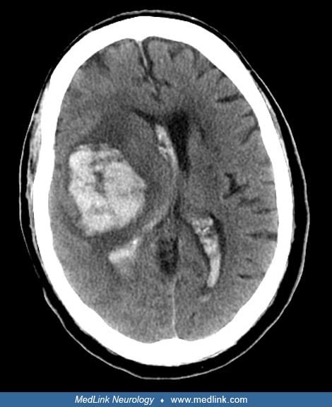 Basal Ganglia Hemorrhage Medlink Neurology