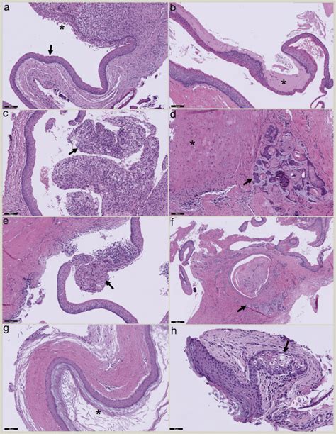 Odontogenic Cysts Classification Histological Features And A