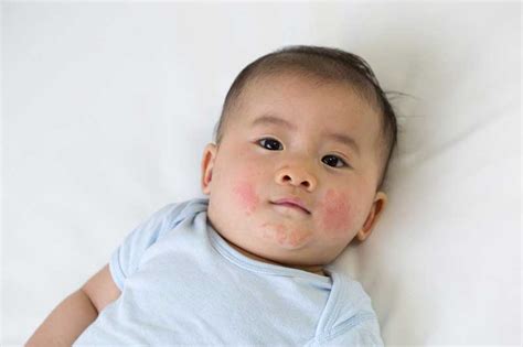 Eczema In Babies And Toddlers Symptoms Causes And Treatment