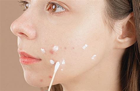 Pros And Cons Of Benzoyl Peroxide Acne Treatment Ensoul Medical Clinic