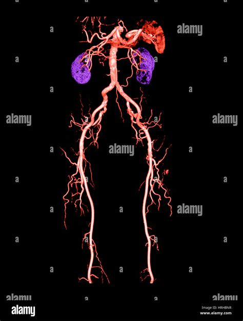 Angiograma Ct De Abdomen Fotos E Imágenes De Stock Alamy