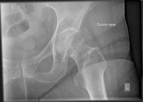 Femoral Neck Fracture Subacute Image