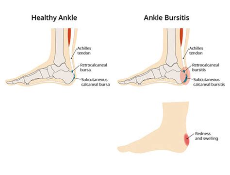 Pain In Back Of Heel Heel Bursitis Symptoms Treatment And