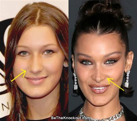 bella hadid plastic surgery comparison photos