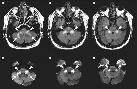 Isolated Bilateral Anterior Inferior Cerebellar Artery Infarction