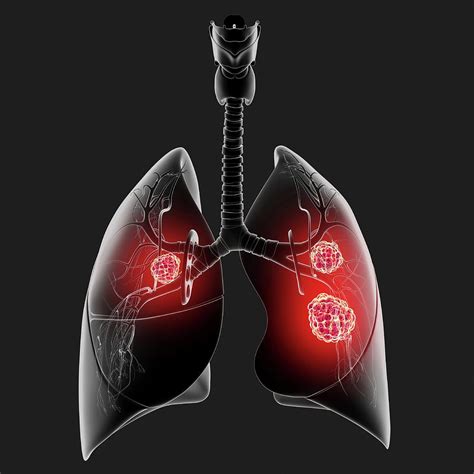 Lung Cancer Photograph By Pixologicstudioscience Photo Library Fine