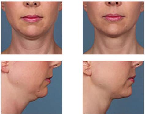 Kybella Injections Miami 305 504 8942 Get Rid Of Double Chin Fat