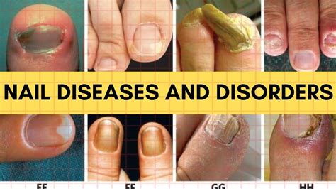 Nail Diseases And Disorders Youtube