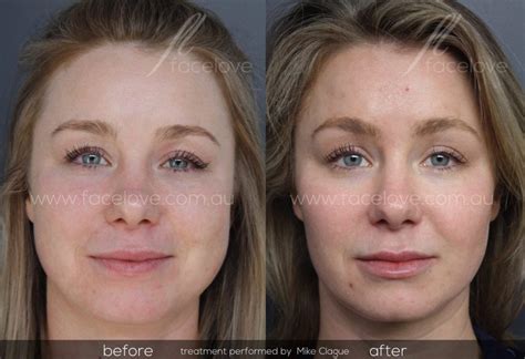 Facial Reshaping And Facial Slimming Facelove