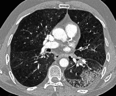 Segmental Pneumonia Lung Ct Scan Stock Image C0384563 Science