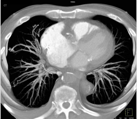 Hereditary Hemorrhagic Telangiectasia Hht With Multiple Pulmonary