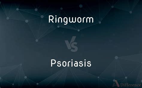 Ringworm Vs Psoriasis — Whats The Difference