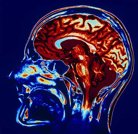 Coloured Mri Scan Of Brain In Sagittal Se Photograph By Geoff Tompkinson