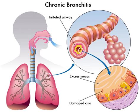 What Is Bacterial Bronchitis With Pictures