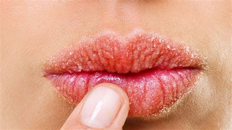 How To Treat Eczema On Your Lips Glamour Us
