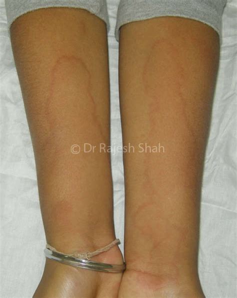 What Is Urticaria Hives All About Urticaria That You Need To Know