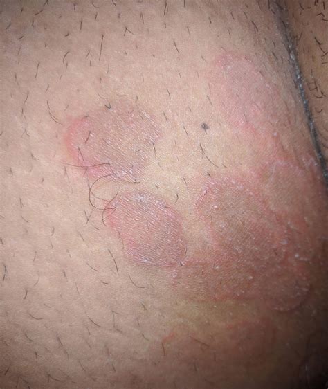Is This Jock Rash On My Inner Thigh Its Been Here For Months On And