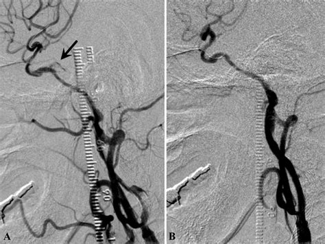Procedural Safety And Potential Vascular Complication Of Endovascular