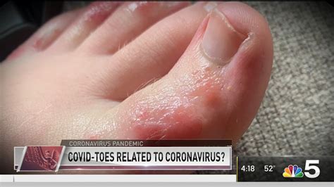 ‘covid Toes Mysterious Skin Condition Could Be Linked To Coronavirus