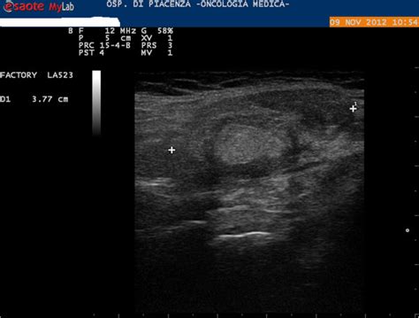 Ultrasound Image Showing A Right Submandibular Salivary Gland