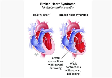 Kuwait Groundbreaking Research Unravels Broken Heart Syndrome Kuwait