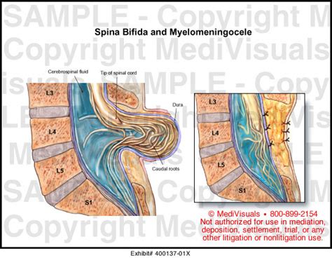 Medivisuals Spina Bifida And Myelomeningocele Medical Illustration