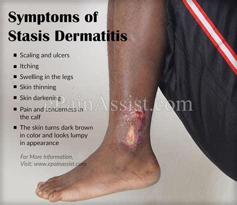 Stasis Dermatitis And Leg Ulcers Causes Symptoms Treatment