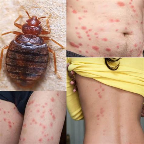 What Do Bed Bug Bites Look Like Signs And Symptoms Decore Of Home Hot