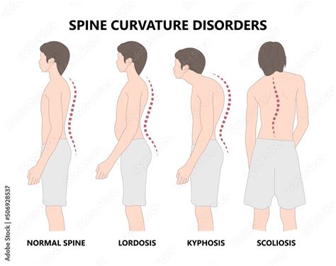 Plakat Spine Forward Head Posture Chest Xray Neck Pain Lumbar