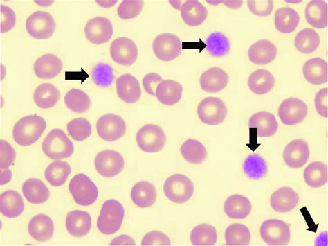 Giant Platelet Appearance In Peripheral Blood Smear In Bernard Soulier