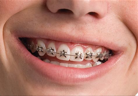 WildSmiles Braces - Dunegan Orthodontics