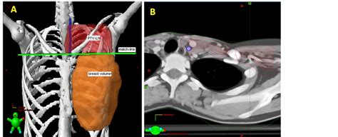 Risk Of Radiation Induced Carotid Artery Stenosis In Supraclavicular